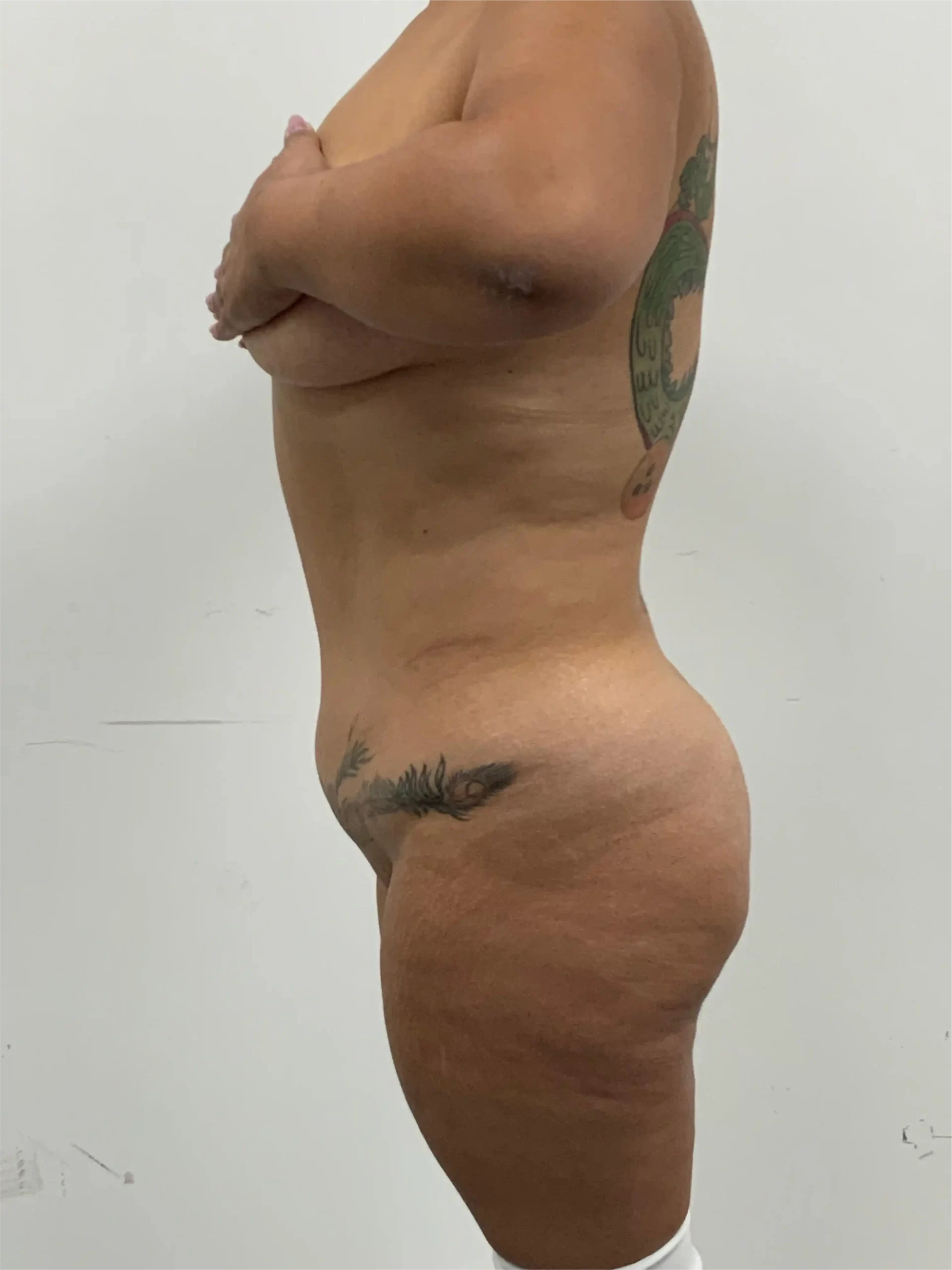 Antes Antes